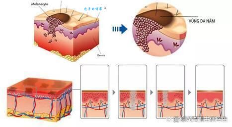 激光美白真的安全吗？揭秘你不知道的副作用